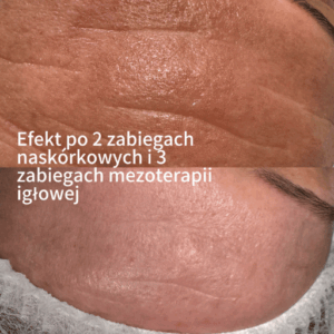 Mezoterapia Igłowa Poznań