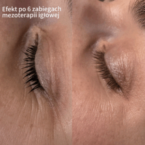 Mezoterapia Igłowa Poznań