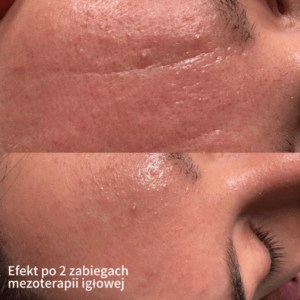 Mezoterapia Igłowa Poznań