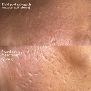 Mezoterapia Igłowa Poznań