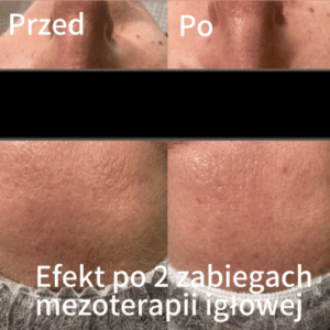 Mezoterapia Igłowa Poznań