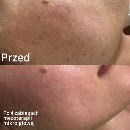 Mezoterapia Mikroigłowa Poznań
