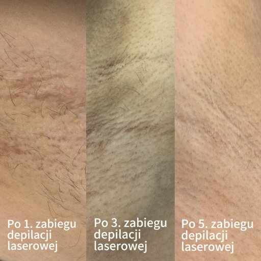 Depilacja laserowa Poznań