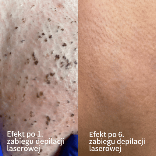 Depilacja laserowa Poznań