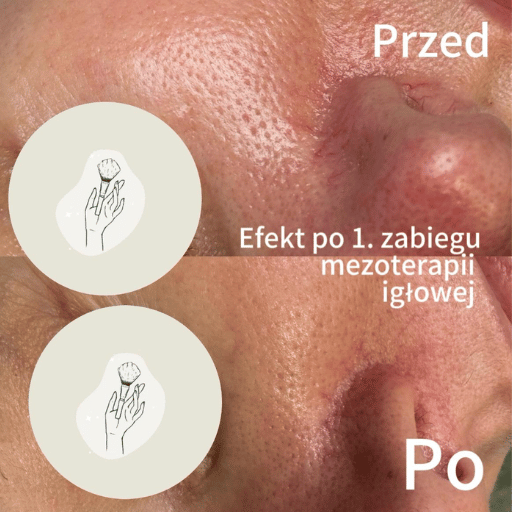 Mezoterapia Igłowa Poznań