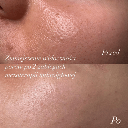 Mezoterapia mikroigłowa poznań
