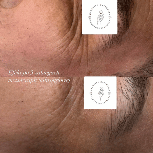 Mezoterapia mikroigłowa poznań